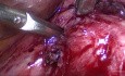 Prevention, Troubleshooting and Management of Complications. Retroperitoneum and Urinary Tract.