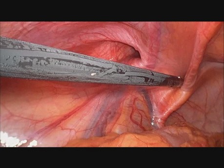 Groin Anatomy in Laparoscopy (Critical View of Myopectineal Orifice)