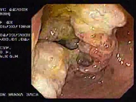 Adenocarcinoma of the Ascending Colon