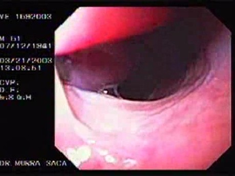 Banding of Esophageal Varices - Appearance of Typical Varices