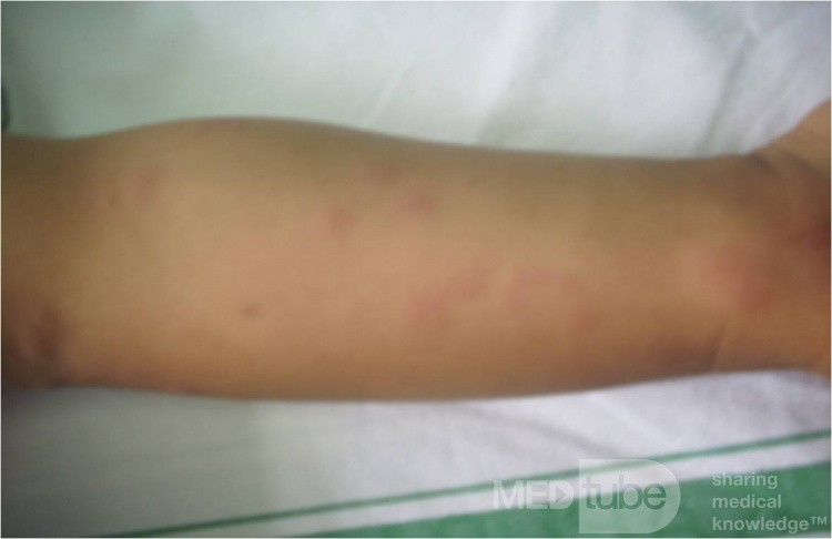 Urticaria