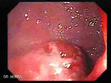 Multiple Adenomatous Polyps Of The Rectum (4 of 37)
