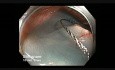 Colonoscopy Channel - Rotation Of The Endoscope Before EMR Of A Flat Lesion