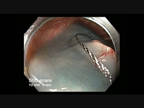 Colonoscopy Channel - Rotation Of The Endoscope Before EMR Of A Flat Lesion