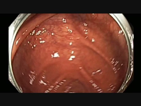 Colonoscopy - Cecum - Subtle Flat Lesion - Scan the Wall
