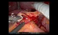 Robotic Transhiatal Esophagectomy (SSAT 2023)
