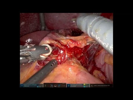 Robotic Transhiatal Esophagectomy (SSAT 2023)