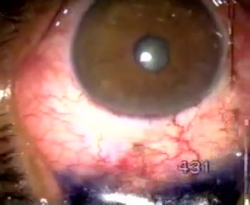 Failed Transciliary Filtration - Resurgery