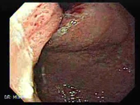 Adenocarcinoma of the cardias (3 of 14)