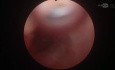 Management of Posterior Urethral Stone