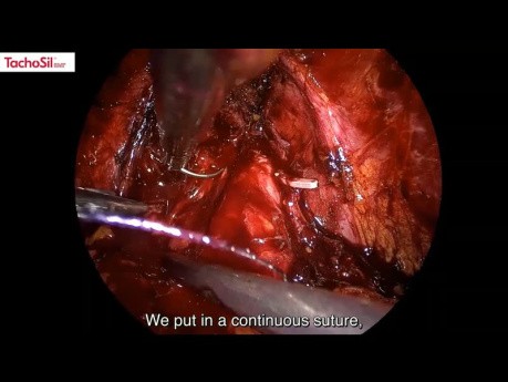 Reconstruction and Sealing of the Urinary Tract using TachoSil® Sealant Matrix in Selected Urological Surgeries