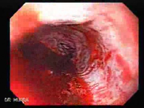 Upper Gastrointestinal Bleeding - Blood Emerging