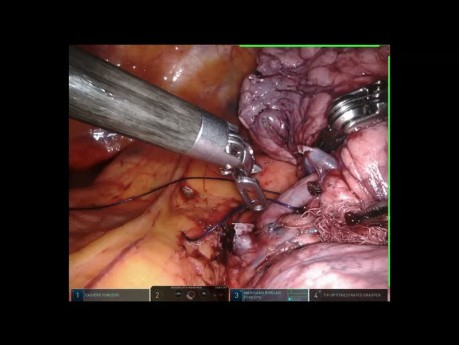 Anatomic Segmentectomy - Robotic Procedure