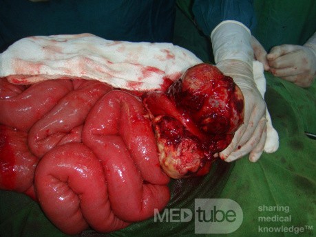 Small bowel obstruction due to Non Hodgkin's lymphoma