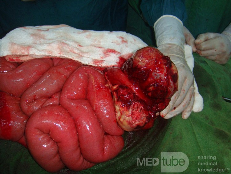 Small bowel obstruction due to Non Hodgkin's lymphoma