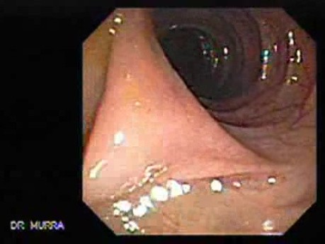 Stalked Polyp - Polypectomy (2 of 6)