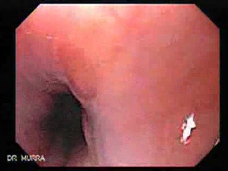 Esophageal Diverticula - Heterotopic Gastric Mucosa