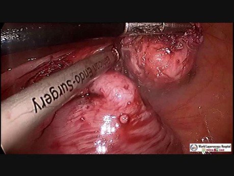 Laparoscopic Myomectomy for Intramural Myoma with Submucosal Extension