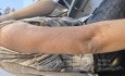 Becker's Nevus (Becker's Melanosis)