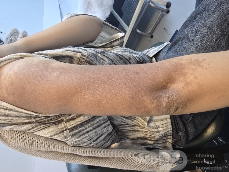 Becker's Nevus (Becker's Melanosis)