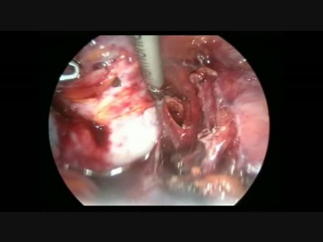 Laparoscopic Bilateral Muscinuse Cystadenoma