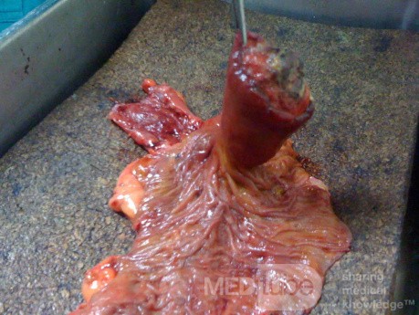 Ascending Colon Intussusception due to a Adenocarcinoma (2 of 6)