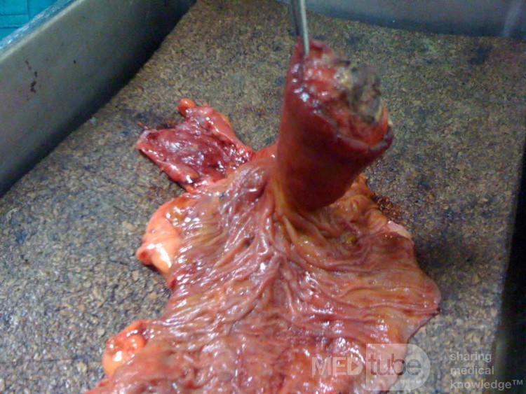 Ascending Colon Intussusception due to a Adenocarcinoma (2 of 6)