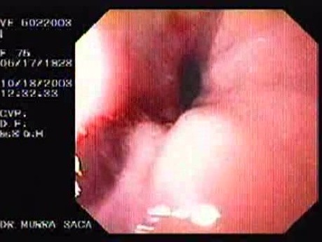 Esophageal Achalasia - Follow Up 5 Days After Treatment
