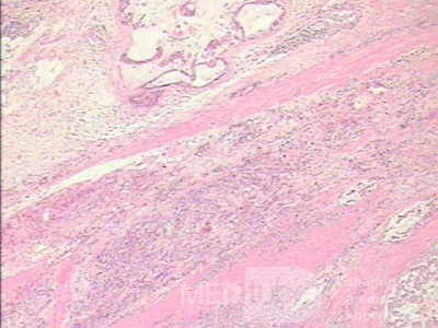 Adenocarcinoma of the cardias and gastric fundus with signet-ring cells (19 of 25)