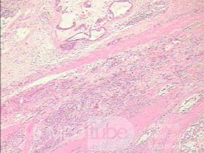 Adenocarcinoma of the cardias and gastric fundus with signet-ring cells (19 of 25)