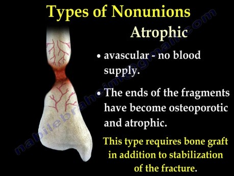 Causes and Treatment of Nonunion Fractures