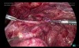 Laparoscopic Enterolysis Removal of Left Hydrosalpingx (part 4)