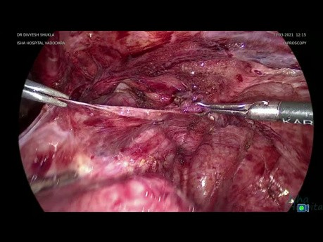 Laparoscopic Enterolysis Removal of Left Hydrosalpingx (part 4)