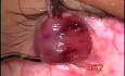 Fugo Blade - inferior oblique myomectomy
