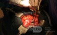 Posterior Wall Pyloroduodenal Perforation