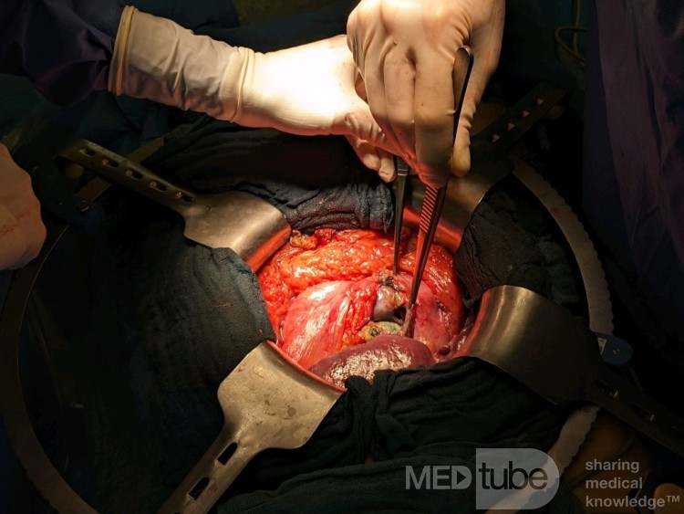 Posterior Wall Pyloroduodenal Perforation