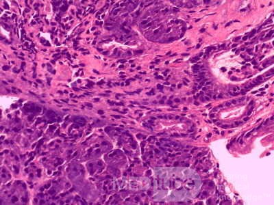 Heterotopic Pancreas with large Central Hole (6 of 6)