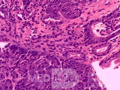 Heterotopic Pancreas with large Central Hole (6 of 6)