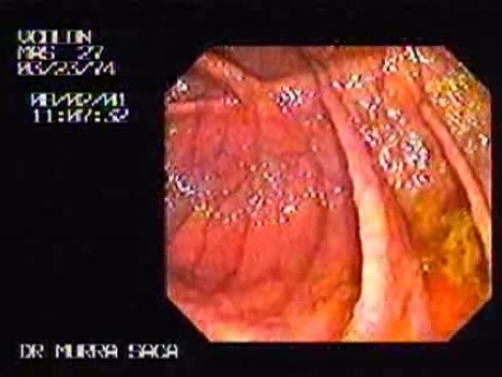 Familial Adenomatous Polyposis of the Colon (4 of 29)