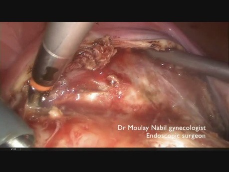 How to Make Simple Complex Myomectomy