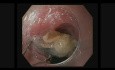Esophageal Foreign Body Removal in the Upper Gastrointestinal Tract
