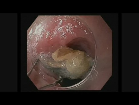 Esophageal Foreign Body Removal in the Upper Gastrointestinal Tract
