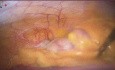 Acute Appendicitis with Pregnancy With Right Oblique Inguinal Hernia and Previous Lap Chole