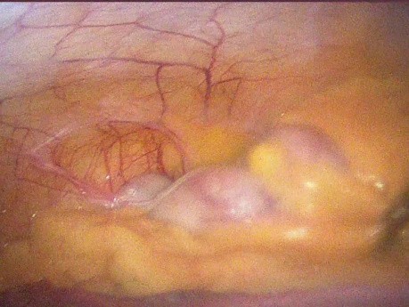 Acute Appendicitis with Pregnancy With Right Oblique Inguinal Hernia and Previous Lap Chole