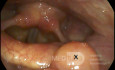 Left Tongue Base Cyst