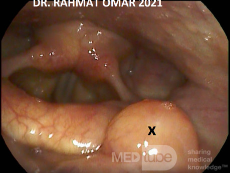 Left Tongue Base Cyst