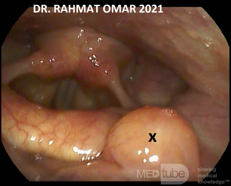 Left Tongue Base Cyst