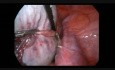 Laparoscopy for Huge Teratoma