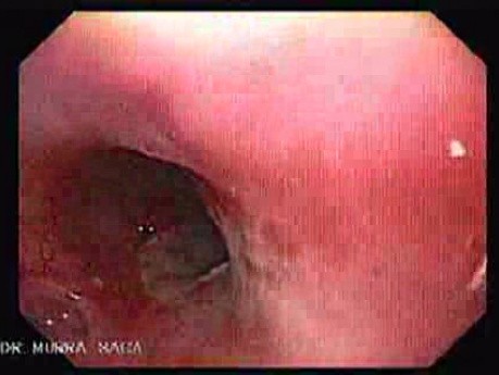 Ulceration Of The Esophagus - Esophagoscopy