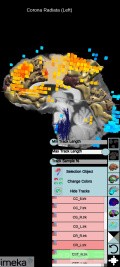 Surgical Planning with Neuronavigator in Patient with Intracranial Mass Lesion. High Grade Glioma.